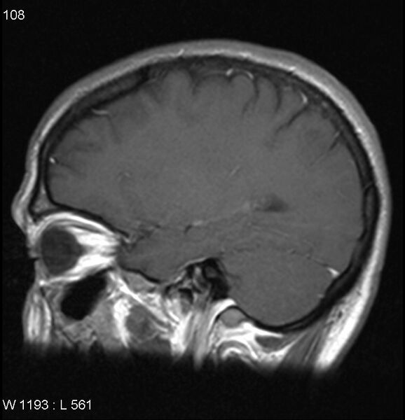 File:Neurosarcoidosis (Radiopaedia 10930-17204 Sagittal T1 C+ 13).jpg
