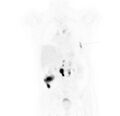 Non-Hodgkin lymphoma involving seminal vesicles with development of interstitial pneumonitis during Rituximab therapy (Radiopaedia 32703-33677 Annotated PET 4).jpg