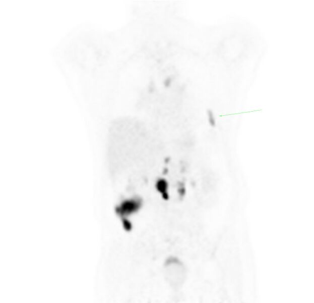 File:Non-Hodgkin lymphoma involving seminal vesicles with development of interstitial pneumonitis during Rituximab therapy (Radiopaedia 32703-33677 Annotated PET 4).jpg