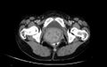 Non-puerperal uterine inversion (Radiopaedia 78343-91094 A 78).jpg
