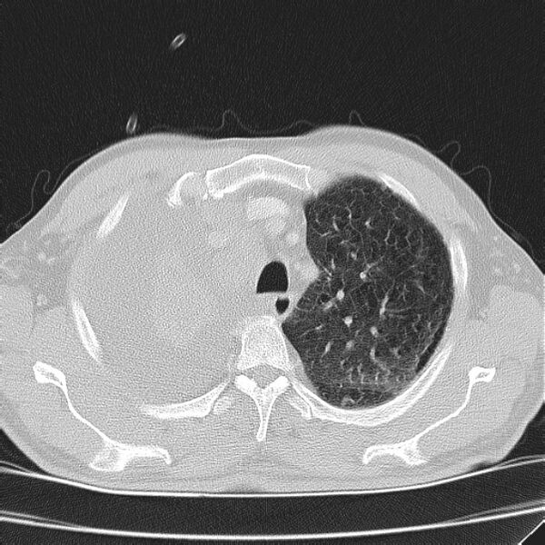 File:Non small-cell lung cancer (Radiopaedia 24467-24769 lung window 10).jpg