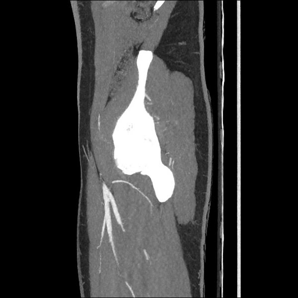 File:Normal CT angiogram of pelvis (Radiopaedia 45390-49430 C 54).jpg