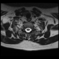 Normal cervical and thoracic spine MRI (Radiopaedia 35630-37156 Axial T2 7).png