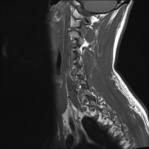 File:Normal cervical spine MRI (Radiopaedia 38418-40496 Sagittal T1 3).jpg
