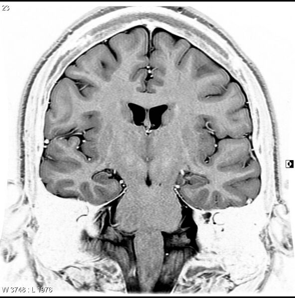 File:Normal coronal brain (Radiopaedia 6676-7910 B 23).jpg