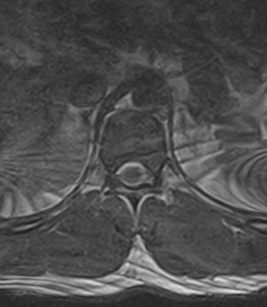 File:Normal lumbar spine MRI - low-field MRI scanner (Radiopaedia 40976-43699 Axial T2 2).jpg