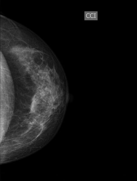 File:Normal mammogram radiographs (Radiopaedia 77107-89068 B 1).jpg