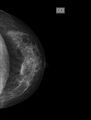 Normal mammogram radiographs (Radiopaedia 77107-89068 B 1).jpg
