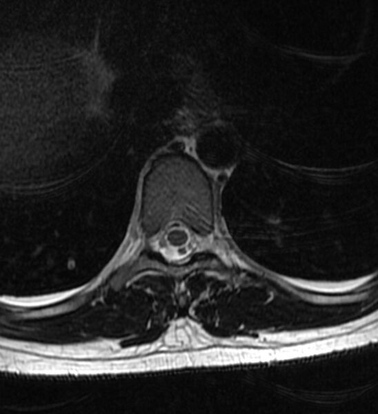 File:Normal thoracic spine MRI (Radiopaedia 41033-43781 Axial T2 11).jpg