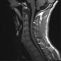 Normal trauma cervical spine (Radiopaedia 41017-43762 Sagittal T1 7).png