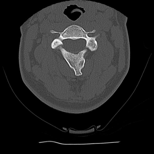 File:Normal trauma spine imaging (Radiopaedia 31753-32686 Axial bone window 27).jpg