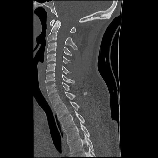 File:Normal trauma spine imaging (Radiopaedia 31753-32686 Sagittal bone window 19).jpg