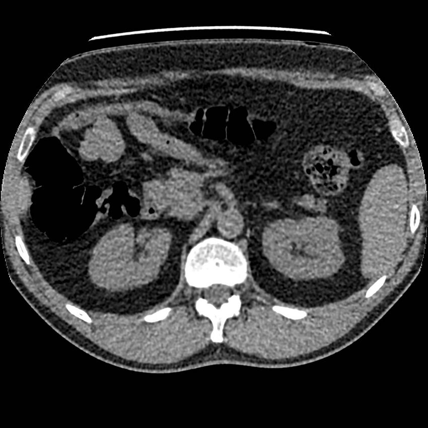 Obstructing ureteric calculus and ureteric anatomy (Radiopaedia 62730-71042 Axial non-contrast 24).jpg