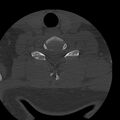 Occipital condyle fracture (Radiopaedia 31755-32691 Axial bone window 62).jpg