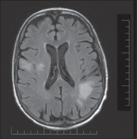 High signal intensity lesion of white matter of dorsal right frontal lobe/right frontal operculum