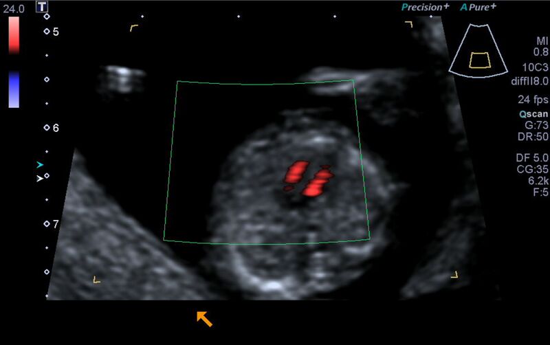 File:1st trimester nuchal-morphology ultrasound (Radiopaedia 44706-48477 Heart views cine with colour 92).jpg