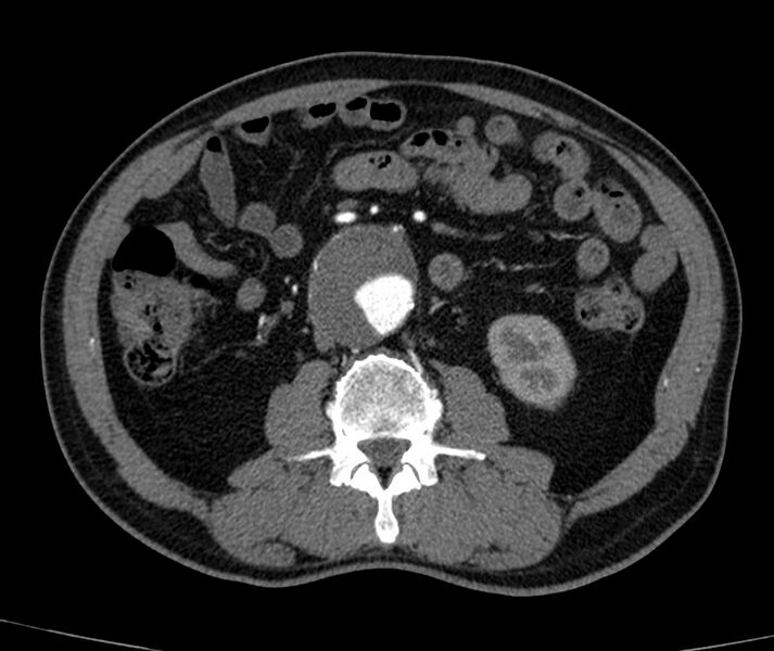 File:Abdominal aortic aneurysm (Radiopaedia 22421-22458 C+ arterial phase 44).jpg