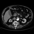 Abdominal aortic aneurysm (Radiopaedia 25855-26001 Axial C+ arterial phase 53).jpg