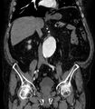 Abdominal aortic aneurysm (Radiopaedia 25855-26001 Coronal C+ arterial phase 32).jpg