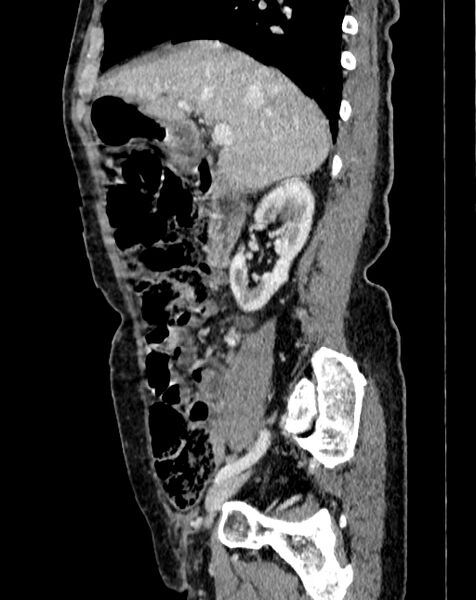 File:Abdominal aortic aneurysm (Radiopaedia 83581-98689 Sagittal C+ portal venous phase 9).jpg