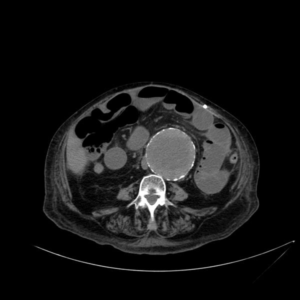File:Abdominal aortic aneurysm - impending rupture (Radiopaedia 19233-19246 Axial non-contrast 73).jpg