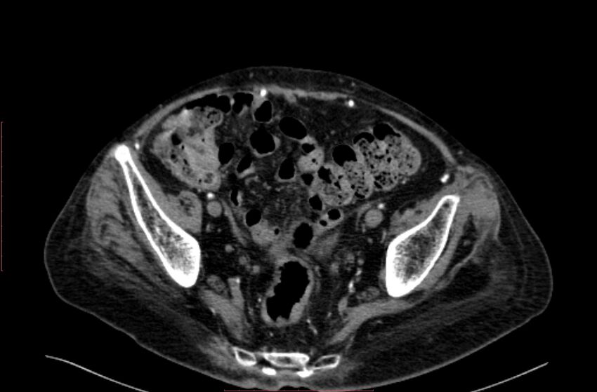 Abdominal aortic interposition tube graft and aneurysm thrombosis (Radiopaedia 71438-81857 Axial C+ arterial phase 194).jpg