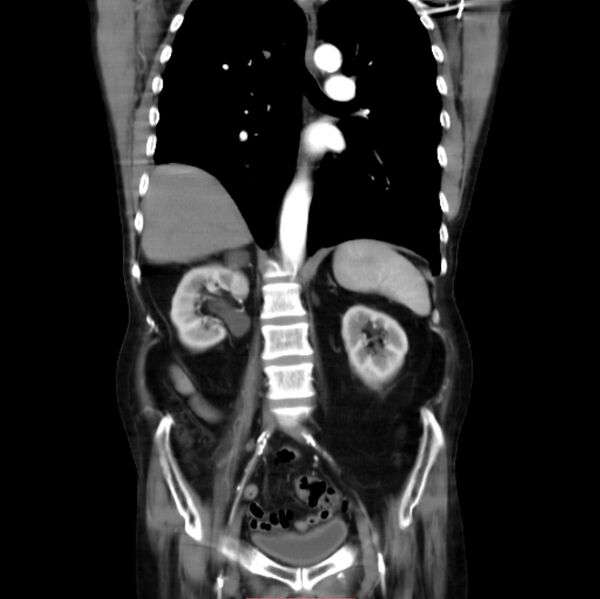 File:Abdominal aortic interposition tube graft and aneurysm thrombosis (Radiopaedia 71438-81857 Coronal C+ arterial phase 16).jpg