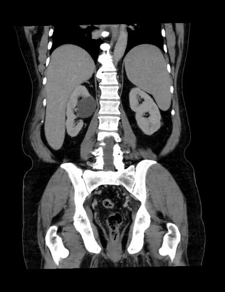 File:Abdominal lymphoma - with sandwich sign (Radiopaedia 53486-59492 C+ portal venous phase 18).jpg