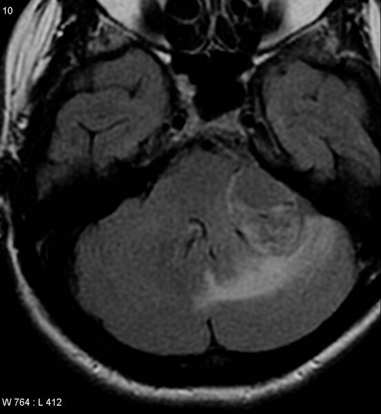 File:Acoustic schwannoma (large with cystic change) (Radiopaedia 5369-7130 Axial FLAIR 4).jpg