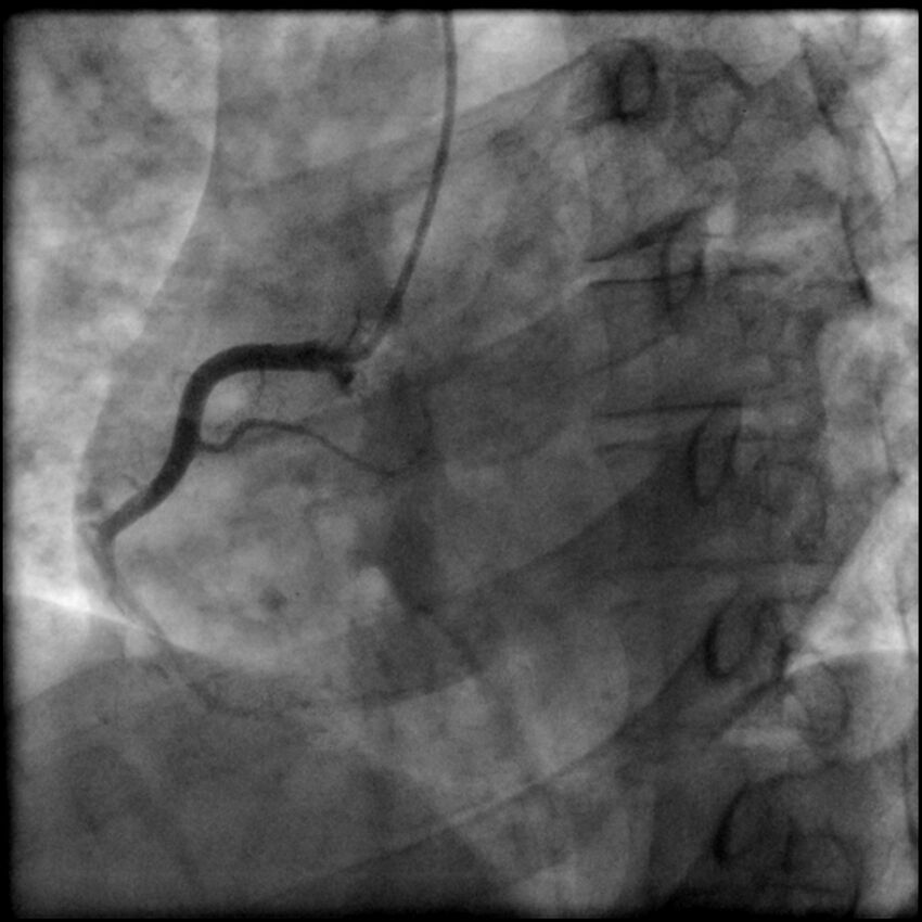 Acute anteroseptal myocardial infarction (Radiopaedia 68409-77946 RAO straight RCA 12).jpg