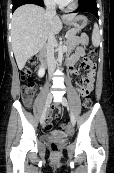 File:Acute appendicitis (Radiopaedia 22892-22918 Coronal C+ portal venous phase 27).png