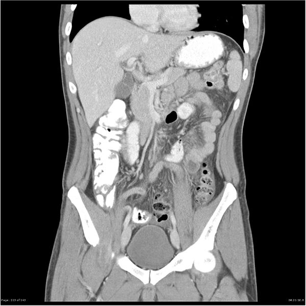 File:Acute appendicitis (Radiopaedia 25364-25615 C+ portal venous phase 10).jpg