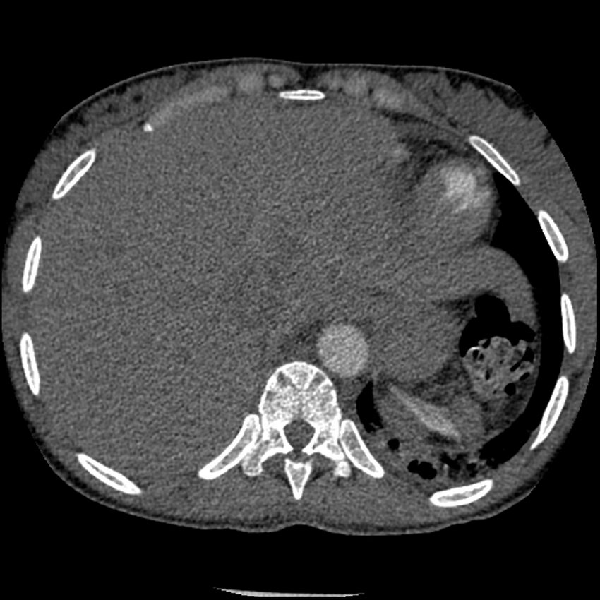 Acute chest syndrome - sickle cell disease (Radiopaedia 42375-45499 Axial C+ CTPA 165).jpg