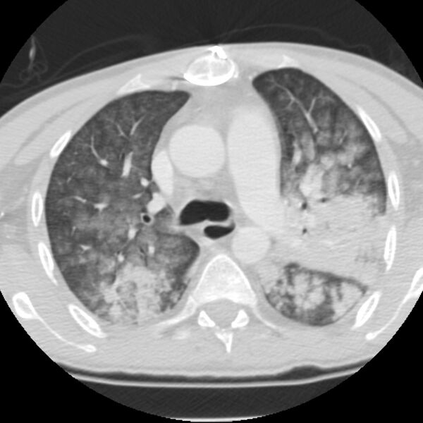 File:Acute diffuse alveolar hemorrhage (Radiopaedia 41323-44158 Axial lung window 20).jpg