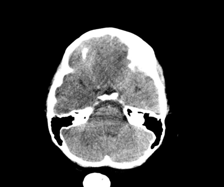 File:Acute epidural hematoma (Radiopaedia 63659-72335 Axial non-contrast 3).jpg