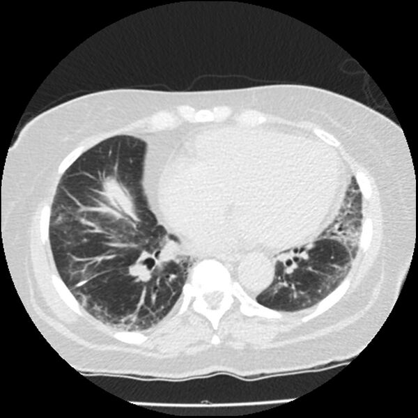 File:Acute interstitial pneumonitis (Radiopaedia 45404-49444 Axial lung window 69).jpg