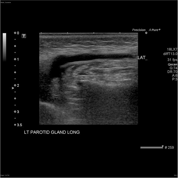 File:Acute left parotid sialadenitis (Radiopaedia 26160-26296 A 3).jpg