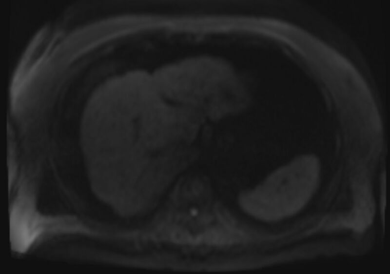 File:Acute portal vein thrombosis (Radiopaedia 73198-83925 Axial DWI 69).jpg
