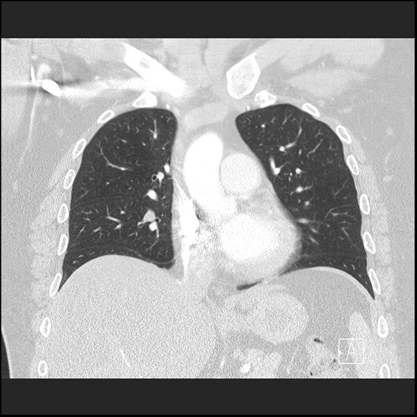 File:Acute pulmonary embolism with pulmonary infarct (Radiopaedia 73062-83768 Coronal lung window 33).jpg