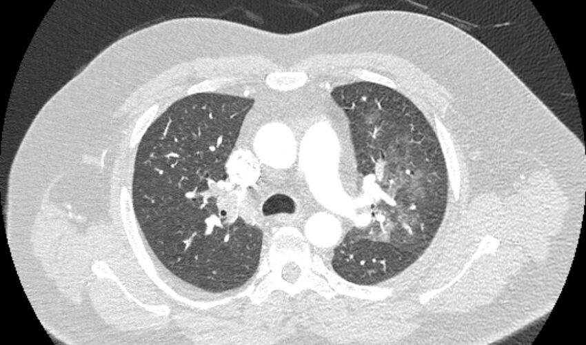 Acute pulmonary embolism with pulmonary infarcts (Radiopaedia 77688-89908 Axial lung window 37).jpg