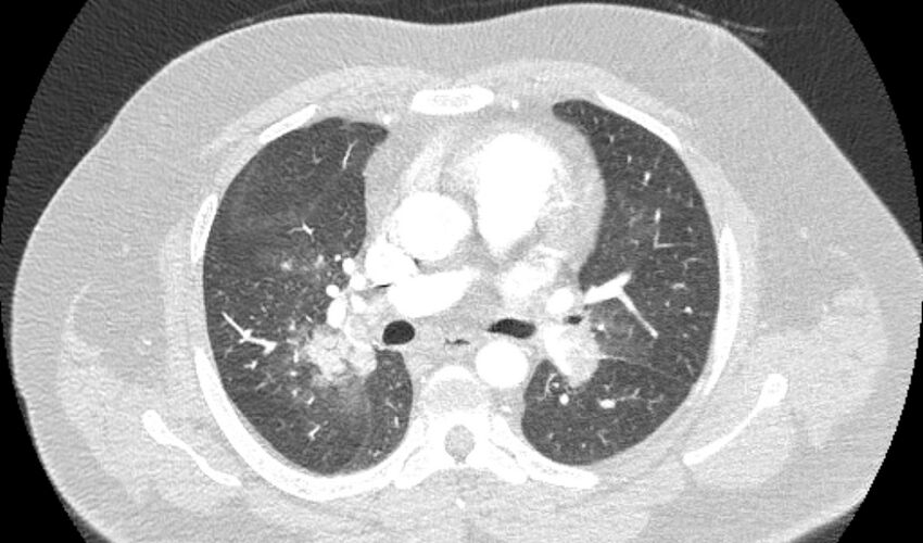 Acute pulmonary embolism with pulmonary infarcts (Radiopaedia 77688-89908 Axial lung window 50).jpg