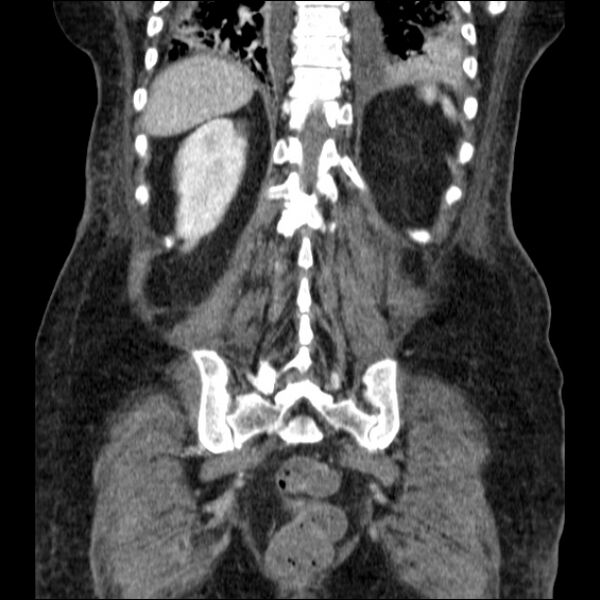File:Acute pyelonephritis (Radiopaedia 26584-26729 C+ portal venous phase 58).jpg