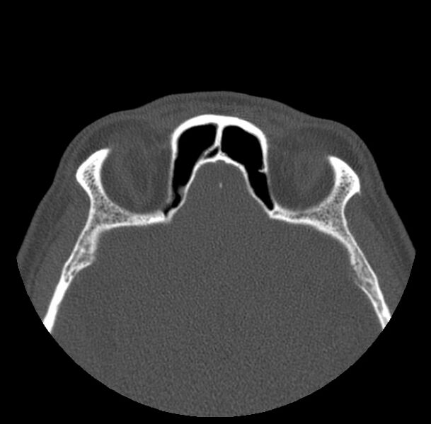 File:Acute sinusitis (Radiopaedia 23161-23215 Axial bone window 61).jpg