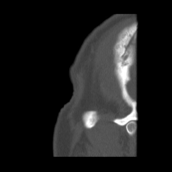 File:Acute sinusitis (Radiopaedia 23161-23215 Sagittal bone window 62).jpg