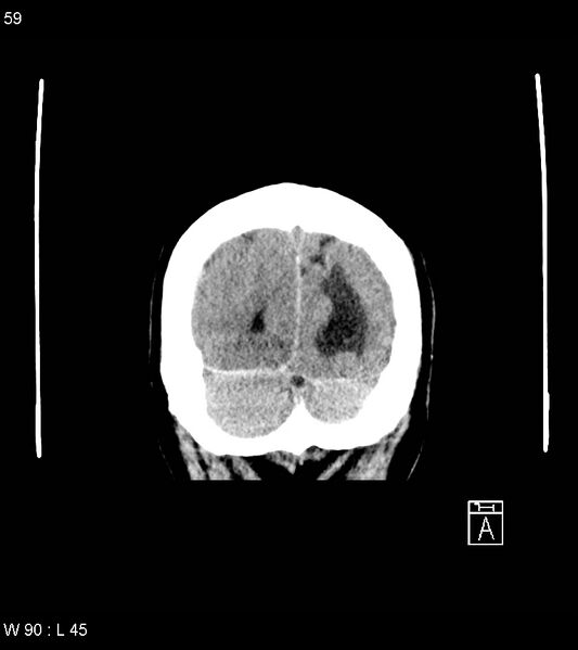 File:Acute subdural hematoma with myelofibrosis (Radiopaedia 52582-58494 Coronal non-contrast 50).jpg