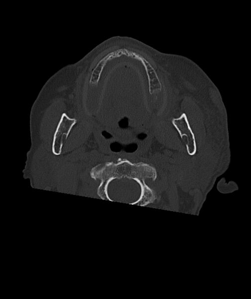 File:Acute traumatic subdural hematoma (Radiopaedia 82921-97257 Axial bone window 110).jpg