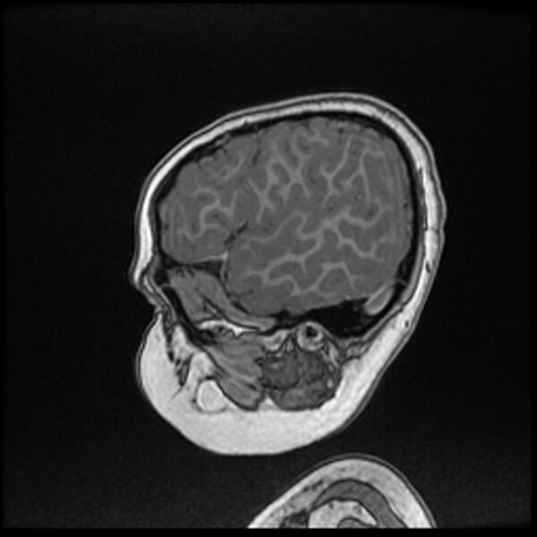 File:Adamantinomatous craniopharyngioma (Radiopaedia 77407-89529 Sagittal T1 C+ 20).jpg