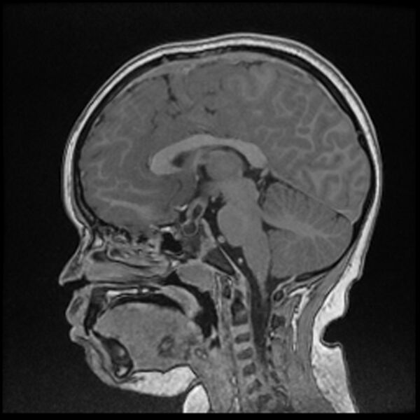 File:Adamantinomatous craniopharyngioma (Radiopaedia 77407-89529 Sagittal T1 C+ 66).jpg