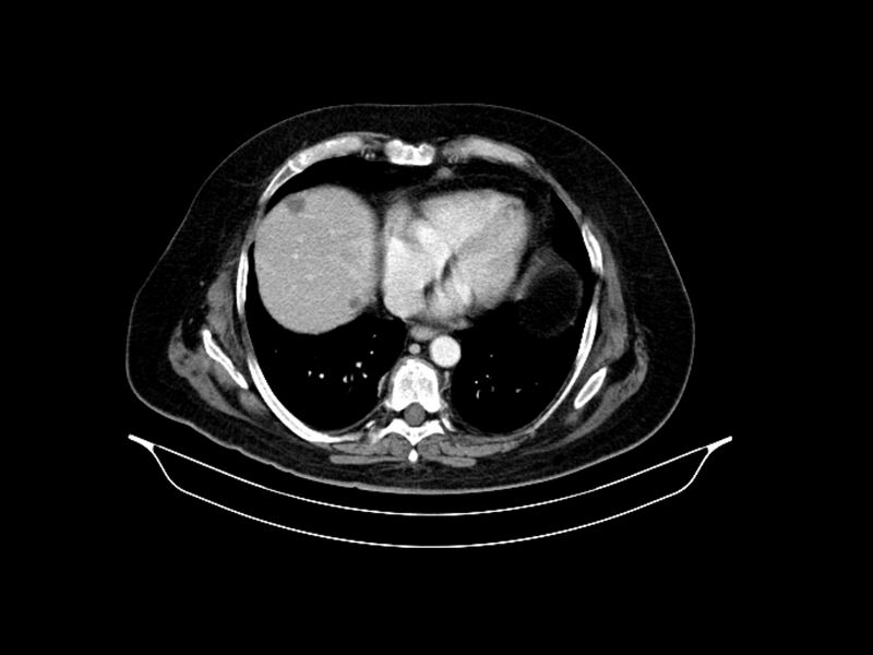 File:Adenocarcinoma of pancreas with hepatic metastasis (Radiopaedia 64332-73122 Axial C+ portal venous phase 13).jpg