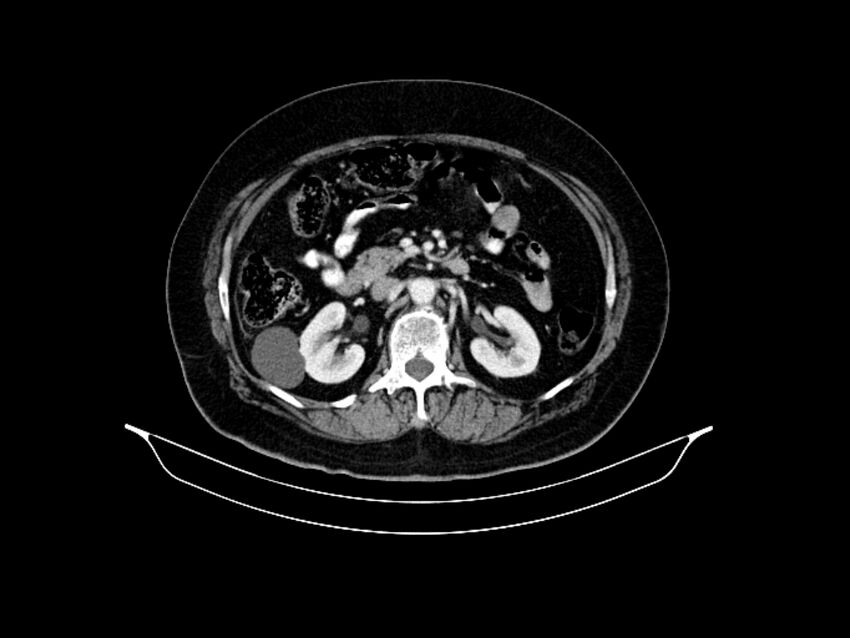 Adenocarcinoma of pancreas with hepatic metastasis (Radiopaedia 64332-73122 Axial C+ portal venous phase 43).jpg